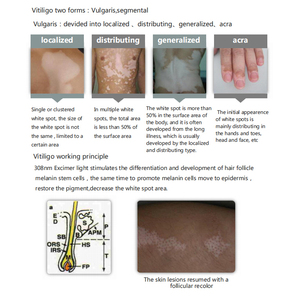 Lámpara UVB de 308nm para Tratamiento de Vitiligo, Luz Excimer de 308nm para Cuidado del Vitiligo, Máquina de Tratamiento de Manchas Blancas de 308nm, Dermatología - Product Image 5