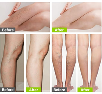 Gel de traitement des varices et des veines d'araignée à absorption rapide et anti-gonflement, composé d'Aescinate de sodium, personnalisé OEM, pour usage domestique, 50G