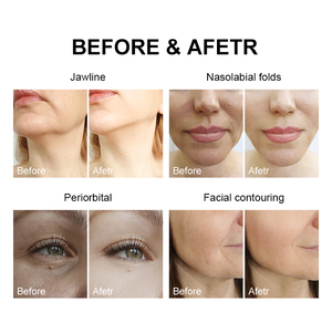 Appareil de beauté multifonctionnel pour le soin de la peau du visage, modelage du corps, resserrement de la peau du visage, raffermissement des ridules, machine de lifting - Product Image 6