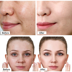 Lifting du visage raffermissant Enzyme Peel masque visage en forme de V levage peau éclaircissant traitement enzymatique Hexapeptide <span class=keywords><strong>poudre</strong></span> lyophilisée - Product Image 5