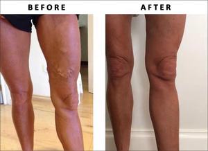 Endolyse Tratamiento de Venas Varicosas Láser <span class=keywords><strong>Endovenoso</strong></span> 980nm 1470nm EVLT Máquina de Eliminación de Vasos Sanguíneos Intravenosos Araña Vasculares - Product Image 5