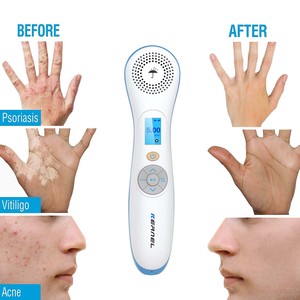 Kernel KN-4003B4 Smalle <span class=keywords><strong>Band</strong></span> <span class=keywords><strong>Uvb</strong></span> Lichttherapie Lamp 308nm Excimer Laser Fototherapie Apparaat Voor Vitiligo Psoriasis Behandeling - Product Image 6
