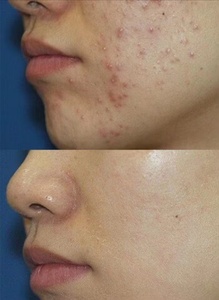 Factory Bulk Skin Care Products for Acne <strong>Remover</strong> Treatment Serum Anti Acne <strong>Pimple</strong> Patch Acne for <strong>Face</strong> Care for <strong>Pimples</strong> - Product Image 5