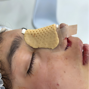 Férula Nasal Termoplástica <span class=keywords><strong>Aquaplast</strong></span> para Rinoplastia, Cirugía de Nariz, Rehabilitación de Fracturas, Inmovilización, Soporte de Fijación - Product Image 1