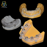 Guide chirurgical personnalisé pour implants dentaires, conception CAD, impression 3D pour un modèle de chirurgie implantaire précise pour la pose d'implants
