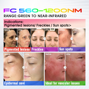 Máquina de Rejuvenecimiento Facial y Corporal BBL <span class=keywords><strong>Plus</strong></span> de Larga Duración, Instrumento Reafirmante Antienvejecimiento de Doble Uso - Product Image 4