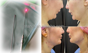 Endolaser Disolución de Grasa Inyectar Fibra Cara Levantamiento Corporal Lipólisis Liposucción 980nm 1470nm Pérdida de Peso Dispositivo de Adelgazamiento Quirúrgico - Product Image 5