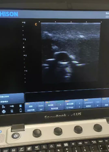 แบบจำลองการเจาะด้วยอัลตราซาวนด์สำหรับการฝึกอบรมการรักษาด้วยอัลตราซาวนด์บริเวณเต้านม พร้อมเนื้องอกสีเหมือนผิวหนัง - Product Image 3