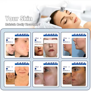 Hydra Beauty Standing Hydro Dermabrasion Machine Oxygen Facial Deep Cleansing Rejuvenation Multi-function Salon Equipment AU - Product Image 6