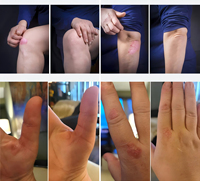 Lampe excimère KERNEL CN-308P5 308 nm pour la thérapie du psoriasis et du vitiligo - Solution de traitement cutané sûre et non invasive