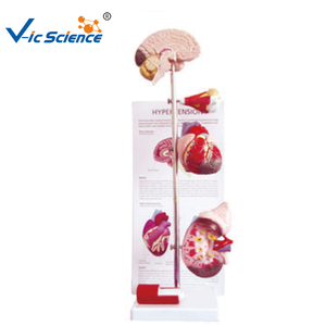 Modelo Anatómico Médico de Patología, Modelo Educativo de Hipertensión, Modelo de Enseñanza de Presión Arterial Alta, Anatomía del Cuerpo Humano - Product Image 1