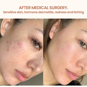 Produits de Soins pour la Peau Sensible <span class=keywords><strong>Anti</strong></span>-Allergie Marque Privée Réparateur Organique Rougeurs <span class=keywords><strong>Visage</strong></span> Sérum <span class=keywords><strong>Visage</strong></span> Crème Hydratante Set de Soins de la Peau - Product Image 4