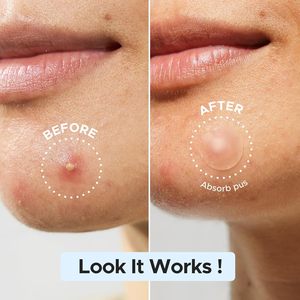 Parches de Hidrocoloide de Grado Médico de Marca Privada Mighty Invisible para el Cuidado de Granos y Acné con Ácido Salicílico para Toda la Cara - Product Image 2