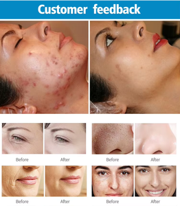 Laser CO2 portable de bureau pour le raffermissement de la peau et la réduction des rides – Traitement du visage, du nez et des lèvres pour la maison et la clinique - Product Image 6