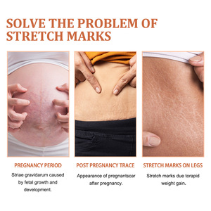 <span class=keywords><strong>Crema</strong></span> reparadora de estrías de fórmula vegana más vendida, piel suave de acción rápida, suave, no irritante <span class=keywords><strong>para</strong></span> el abdomen, muslos, pecho - Product Image 3