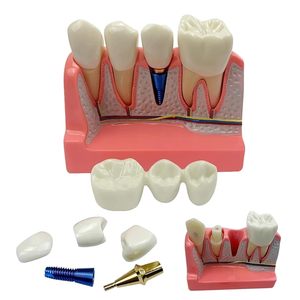 Modèle d'implant dentaire 4-en-1 avec couronne amovible, pont dentaire et facettes en porcelaine pour l'étude et la démonstration pédagogique - Product Image 2