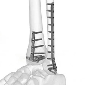 Instruments chirurgicaux pour traumatismes, instruments chirurgicaux orthopédiques réutilisables en acier inoxydable de haute qualité pour usage hospitalier et clinique - Product Image 4