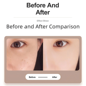 Stylo anti-taches et verrues rechargeable à 9 niveaux de puissance pour l'élimination des grains de beauté, verrues, taches de rousseur, nævus, taches brunes et petits tatouages - Product Image 5
