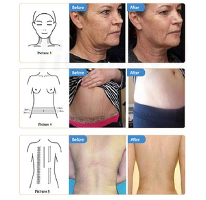 Lipo Masaje Rodillo de vacío Masajeador Reducción de celulitis Eliminación de arrugas Cuerpo Adelgazamiento Contorno Máquina de belleza - Product Image 4