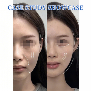 Stimulateur de collagène longue durée PDLLA (acide poly-D-L-lactique) – Billes lyophilisées pour la restauration du volume, l'élimination <span class=keywords><strong>des</strong></span> rides et le lifting du visage - Product Image 2