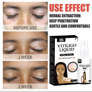 Produsen Grosir Krim Kesehatan <span class=keywords><strong>Vitiligo</strong></span> Produk Perawatan Kulit Bahan Herbal Semprotan Cair <span class=keywords><strong>Vitiligo</strong></span> - Product Image 6