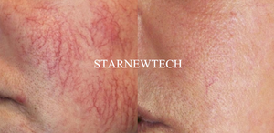 I vasi sanguigni rossi indolori 980nm rimuovono la macchina <span class=keywords><strong>Laser</strong></span> medica a diodi per rimozione vascolare ad alta frequenza della vena del ragno - Product Image 3