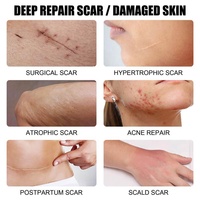 Private Label più veloce forte efficace crema per la rimozione delle cicatrici da Acne Gel Acar crema per la riparazione delle cicatrici da pancia