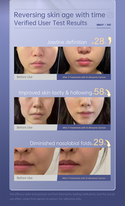 Appareil de soin du visage pour le lifting, l'élimination des rides et le raffermissement de la peau, appareil de beauté pour usage domestique - Product Image 5