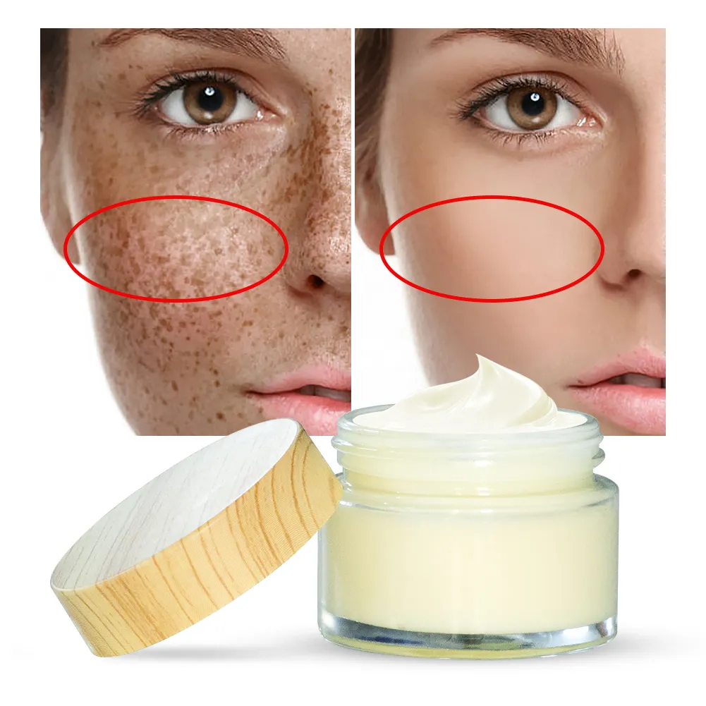 Pronto per la spedizione crema per la rimozione dell'acne crema per il viso giorno e notte con etichetta privata per l'acne