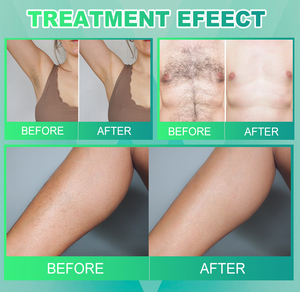 Pha Trộn Điện Phân-Tóc-Loại Bỏ-Máy 2 Trong 1 Sắc Tố Loại Bỏ Trên Khuôn Mặt Và Cơ Thể Điện Tóc Loại Bỏ Thiết Bị Cho Salon - Product Image 4