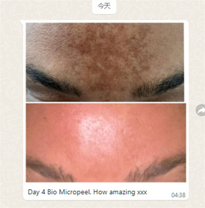Salon Custom ized/Private Logo Verfügbar Spong illa Spicules Haut Peeling Akne Pigmentierung Massage Verwenden Sie natürliche nicht chemische Säure - Product Image 3