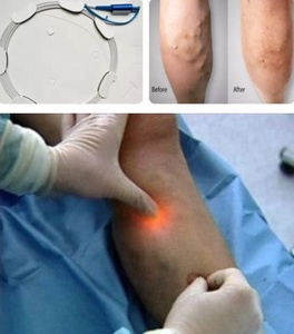 Vericose medis menghilangkan Laser Diode endovenosa 980nm 1470nm intravena darah iradiasi perangkat penghapus pembuluh darah Spider - Product Image 3
