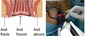 Removedor de pilas Cirugía Hemorroides Sonda láser 1470nm 980nm Fístula Anal Hemorroidoplastia Urología Proctología Máquina médica - Product Image 6