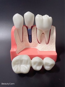 Modèle de dents dentaires modèle de Solution d'<span class=keywords><strong>implant</strong></span> 4 fois restauration de prothèse <span class=keywords><strong>dentaire</strong></span> explication d'<span class=keywords><strong>implant</strong></span> <span class=keywords><strong>dentaire</strong></span> <span class=keywords><strong>couronne</strong></span> de pont détachable - Product Image 2