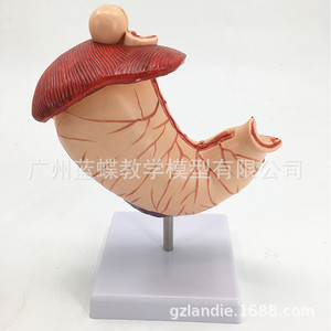 Modelo anatómico gástrico, modelo de estómago con enfermedades, modelo de demostración de enfermedades gástricas, modelo de estómago patológico, humano - Product Image 5