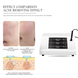 OEM ODM Personal Care Equipment Sonic Acne Treatment Skin Whitening Beauty Machine - Product Image 4