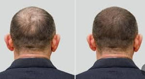 Bonnet à l'Ozone avec Bonne Étanchéité pour Traitement du Cuir Chevelu et Soin des Cheveux - Product Image 3