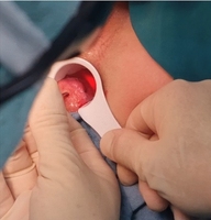 Appareil médical professionnel 980nm+1470nm 47W pour la chirurgie proctologique, le traitement des hémorroïdes et des fistules anorectales