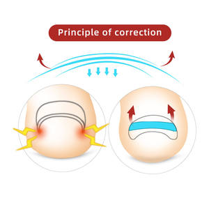 Tiras Correctoras para Uñas Encarnadas, Parche de Tratamiento para Uñas de los Pies, Corrector Adhesivo, Herramientas de Pedicura, Corrector de Uñas de los Pies - Product Image 3