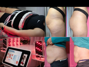 Máquina Profesional de Adelgazamiento Lipoláser 5D de 650nm para Quemar Grasa, Anticelulitis, Contorno Corporal Completo y Terapia de Luz Roja con Almohadillas - Product Image 5