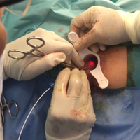 Machine médicale chirurgicale de proctologie, traitement au laser diode 980 nm 1470 nm, proctologie, hémorroïdes, fistule anale, piles
