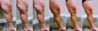 Haute puissance 980nm enlèvement Laser varices 1470nm Diode Laser Mini-invasif EVLT varices chirurgie dispositif de traitement