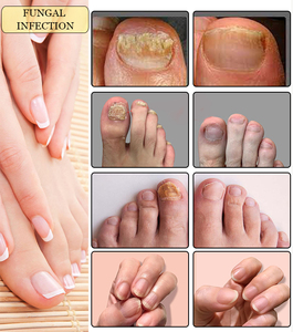 980nm Diodo Láser Equipo Podología Uñas Hongo Onicomicosis Láser - Product Image 5