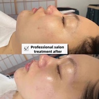 Sérum exfoliant double action AHA PHA six acides et trois enzymes pour le traitement professionnel des pores ouverts en salon