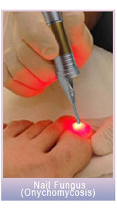 Láser de Diodo de 980nm para <span class=keywords><strong>Hongos</strong></span> en las <span class=keywords><strong>Uñas</strong></span>, Máquina de <span class=keywords><strong>Tratamiento</strong></span> de <span class=keywords><strong>Hongos</strong></span> en las <span class=keywords><strong>Uñas</strong></span> con Láser de Podología - Product Image 4