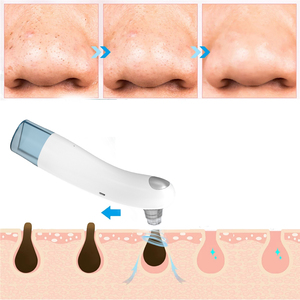 Kit Estrattore di <span class=keywords><strong>Punti</strong></span> <span class=keywords><strong>Neri</strong></span> e Comedoni, Aspiratore <span class=keywords><strong>per</strong></span> Pori Ricaricabile con Tecnologia a Bolle d'Acqua <span class=keywords><strong>per</strong></span> Pulizia dei Pori e Trattamento dell'Acne - Product Image 5