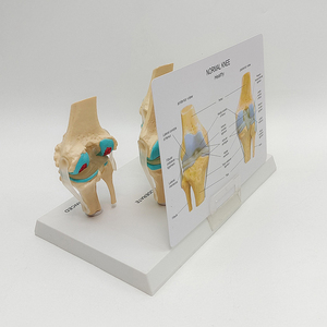 Modelo Anatómico de <span class=keywords><strong>Esqueleto</strong></span> <span class=keywords><strong>Humano</strong></span> de Tamaño Real, Modelo de Articulación de <span class=keywords><strong>Rodilla</strong></span> Enferma en 4 Etapas para Enseñanza - Product Image 6