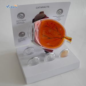 Modelo de Cataratas de Alta Calidad, Modelo de Glaucoma, Modelo de Ojo Patológico para Educación y Enseñanza. - Product Image 1