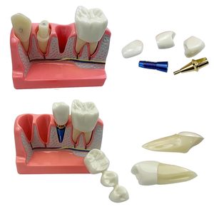 Modèle d'implant dentaire 4-en-1 avec couronne amovible, pont dentaire et facettes en porcelaine pour l'étude et la démonstration pédagogique - Product Image 6