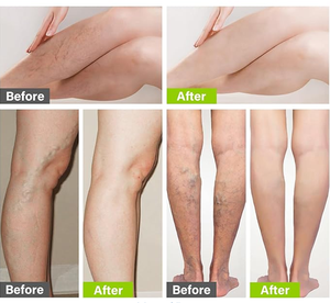 Crème pour <span class=keywords><strong>varices</strong></span> <span class=keywords><strong>Traitement</strong></span> des <span class=keywords><strong>varices</strong></span> pour le soulagement de la douleur des jambes 50g OEM ODM - Product Image 6